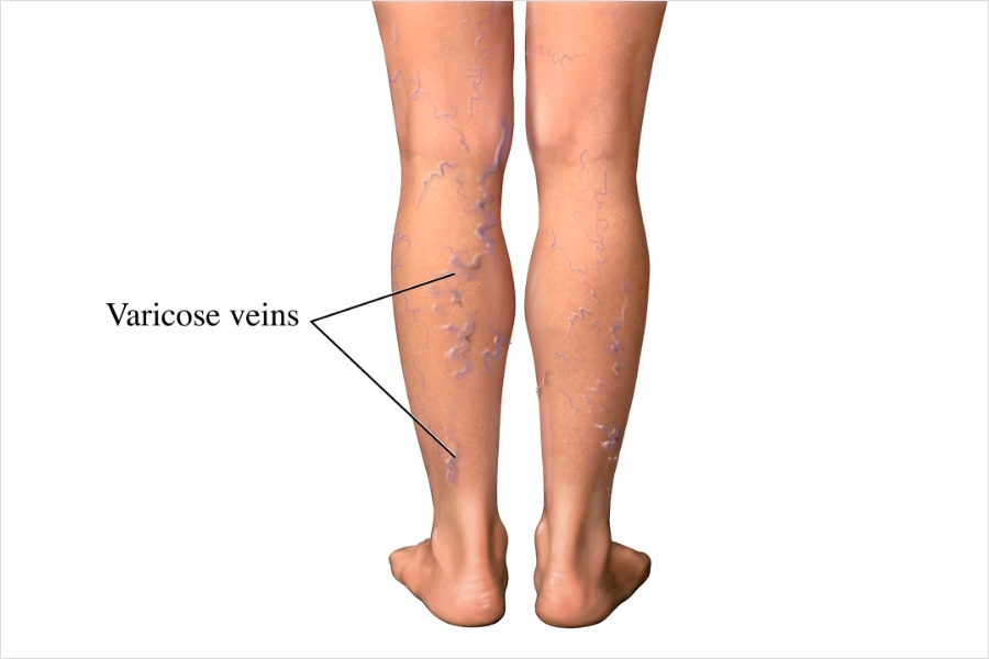 What Varicose Veins