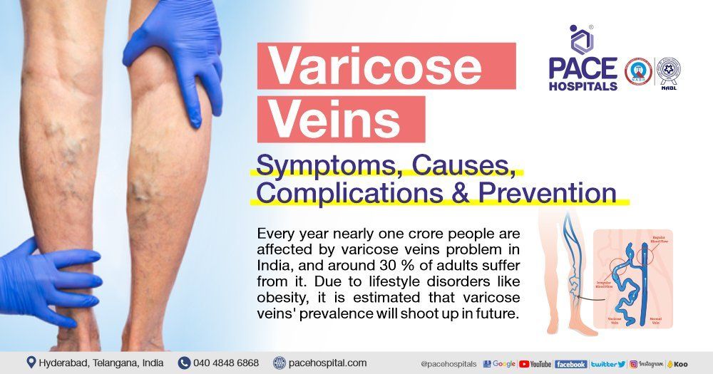 Defining Varicose Veins