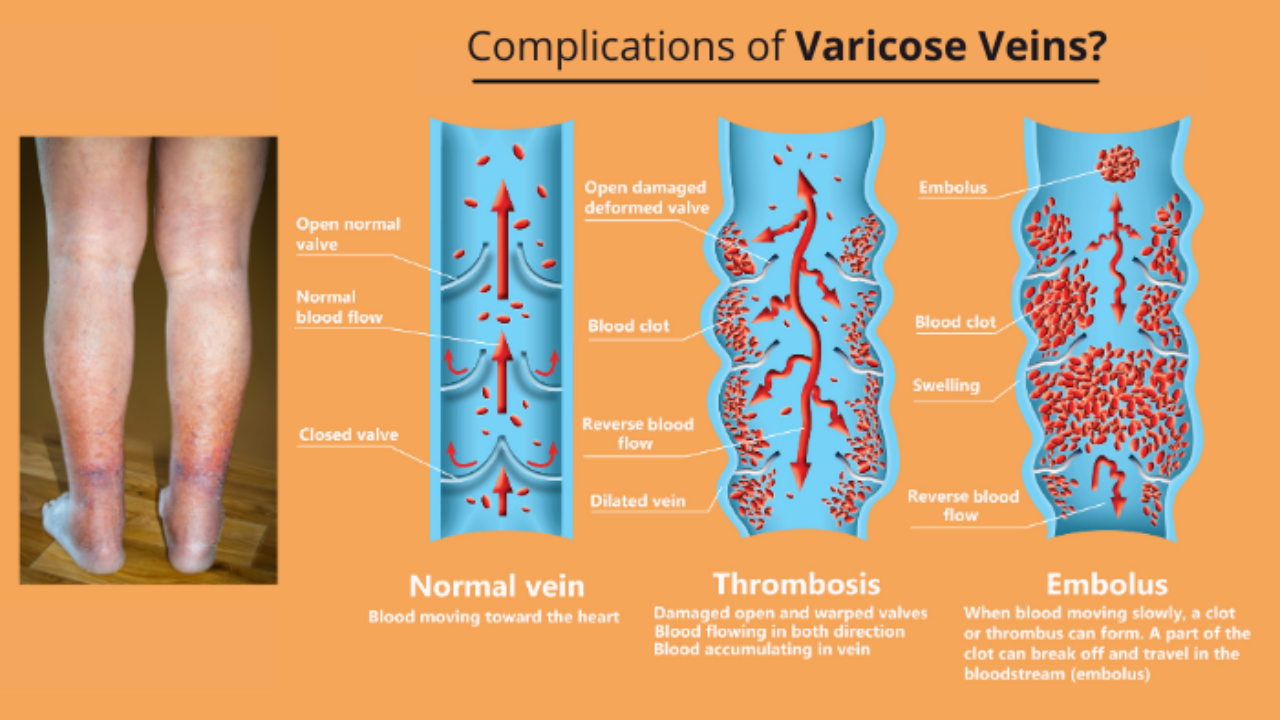 Potential Complications Varicose Veins