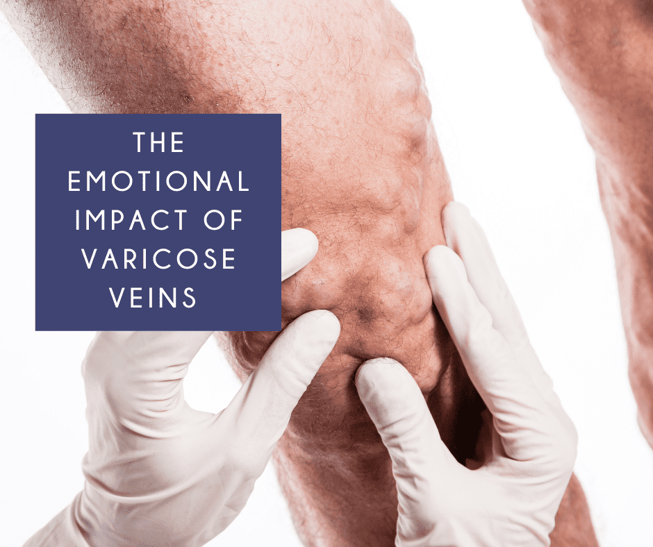 Psychological Impact Varicose Veins