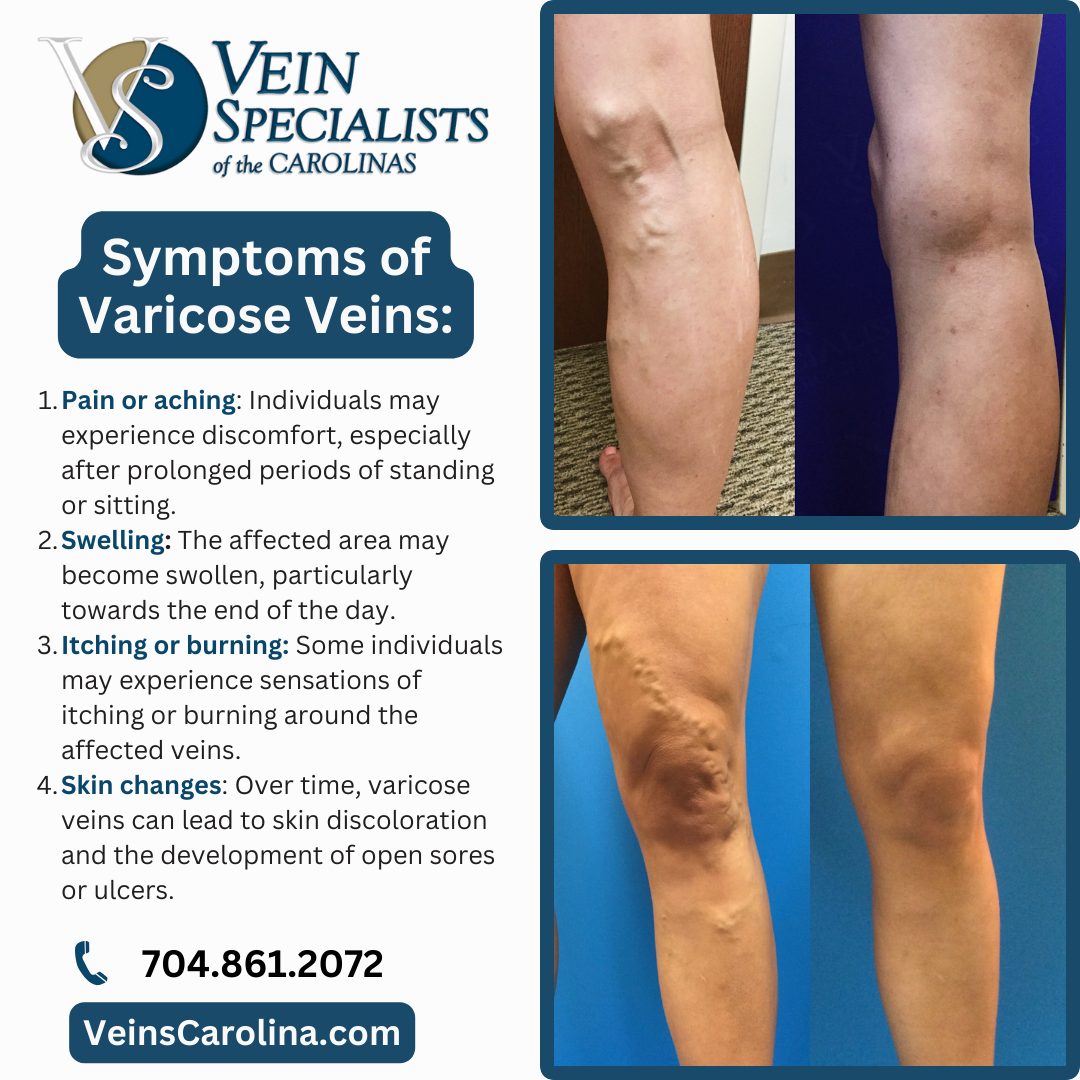 Symptoms Associated with Varicose Veins